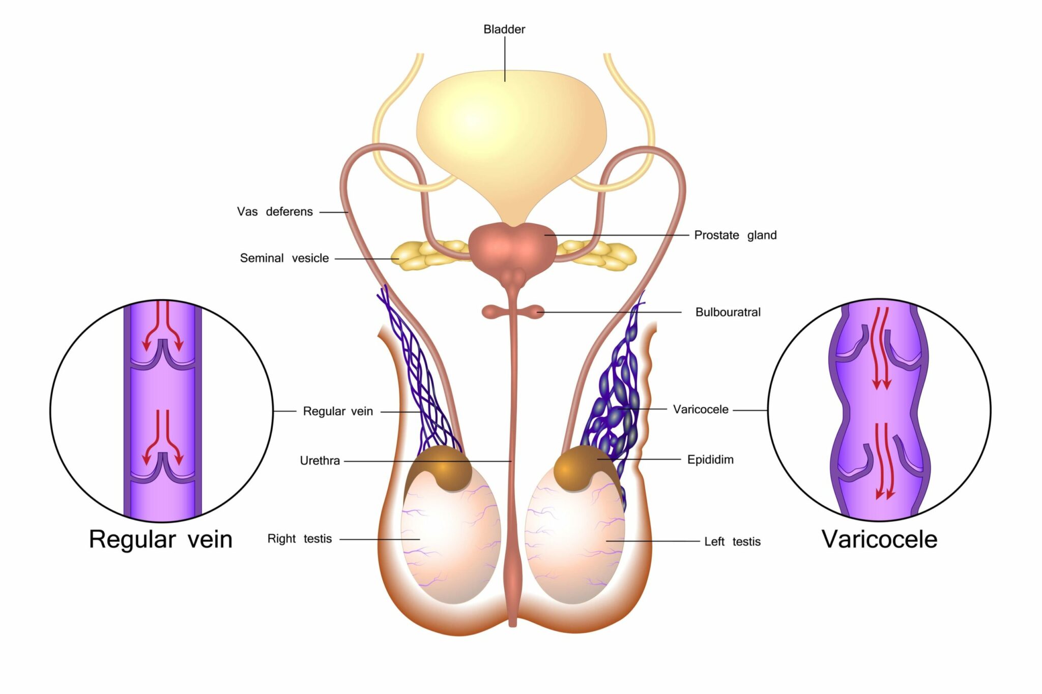 Varicocele causes and treatment